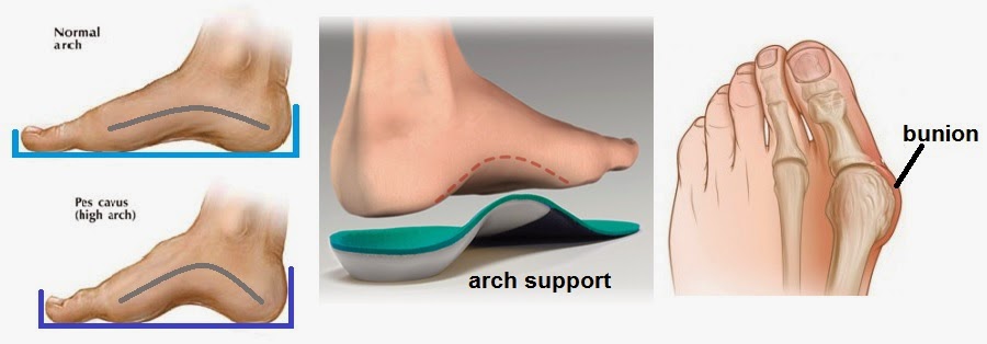 normal arch bunion support